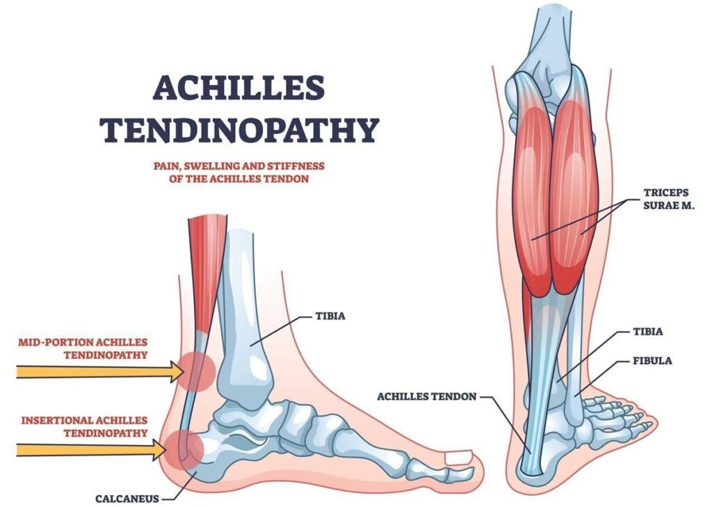 Achilles-Tendinopathy-1