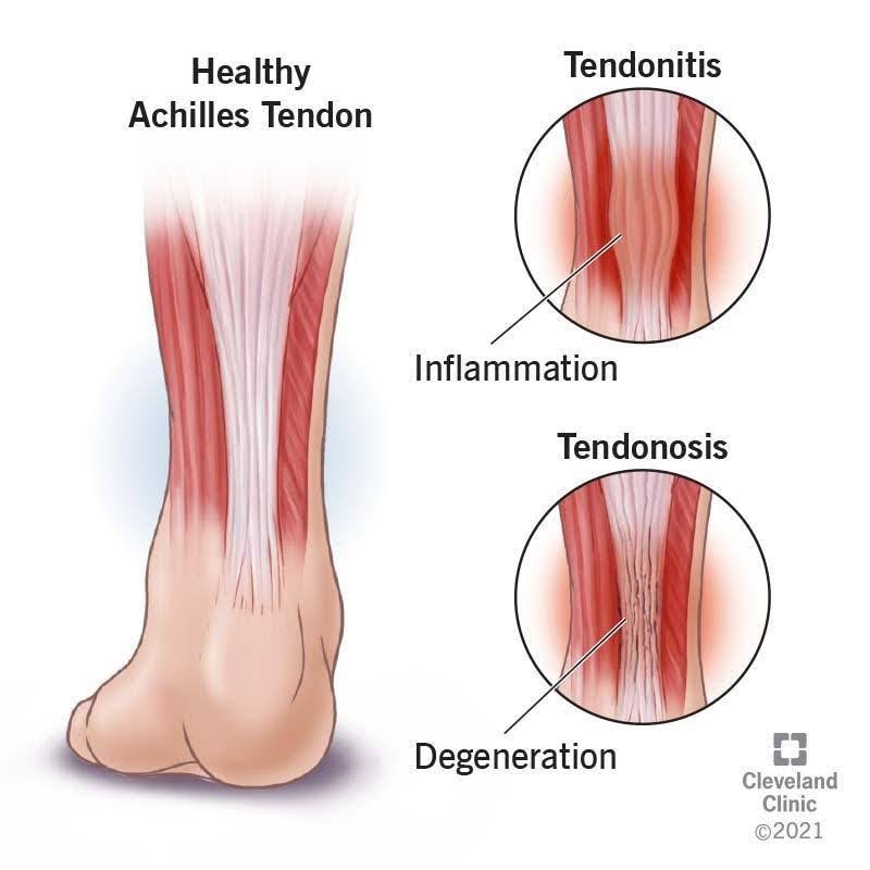 Achilles-Tendinopathy-2