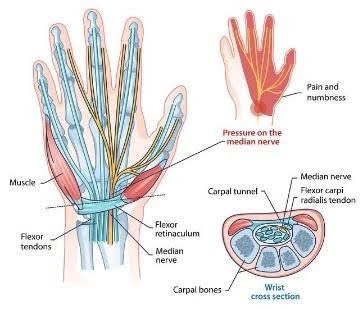 Carpal-Tunnel-Syndrome-1