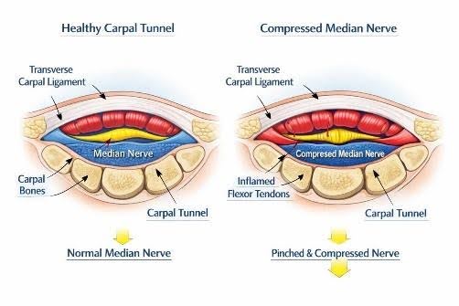 Carpal-Tunnel-Syndrome-2