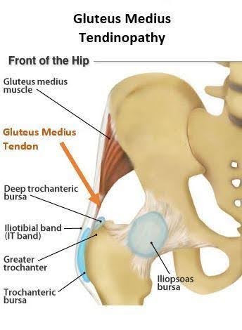 Gluteal-Tendinopathy-1