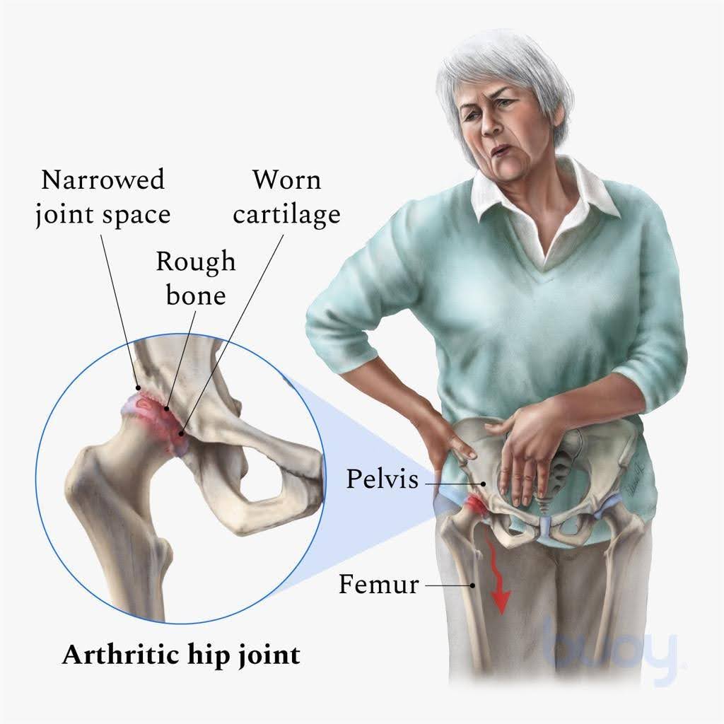 Hip-Osteoarthritis-2