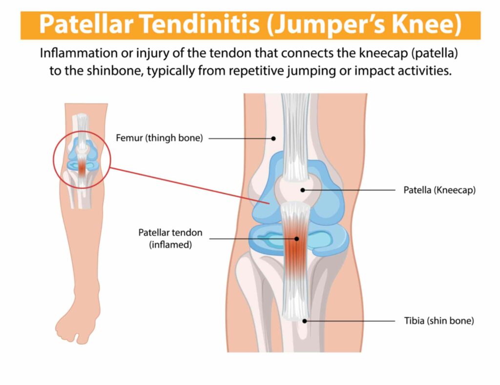 Knee Patellar