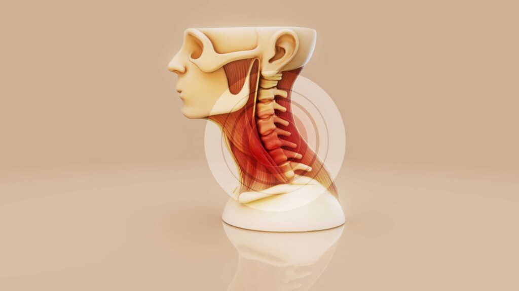 Neck Whiplash