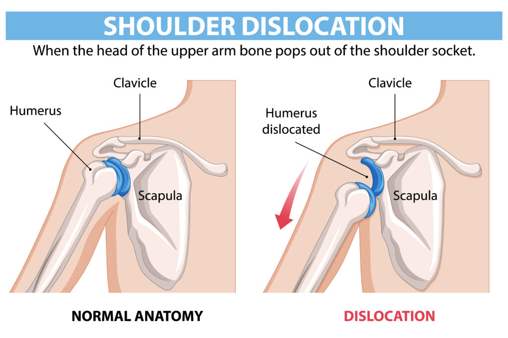Shoulder Dislocation Anatomy Illustration